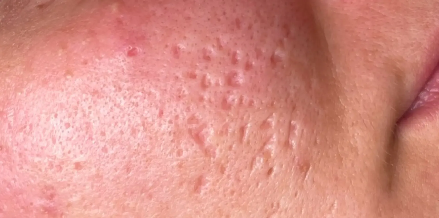 mezoterpiaosoczeprzed